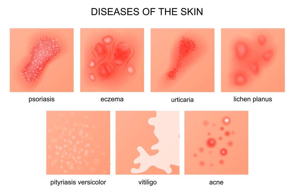 diseases of the skin